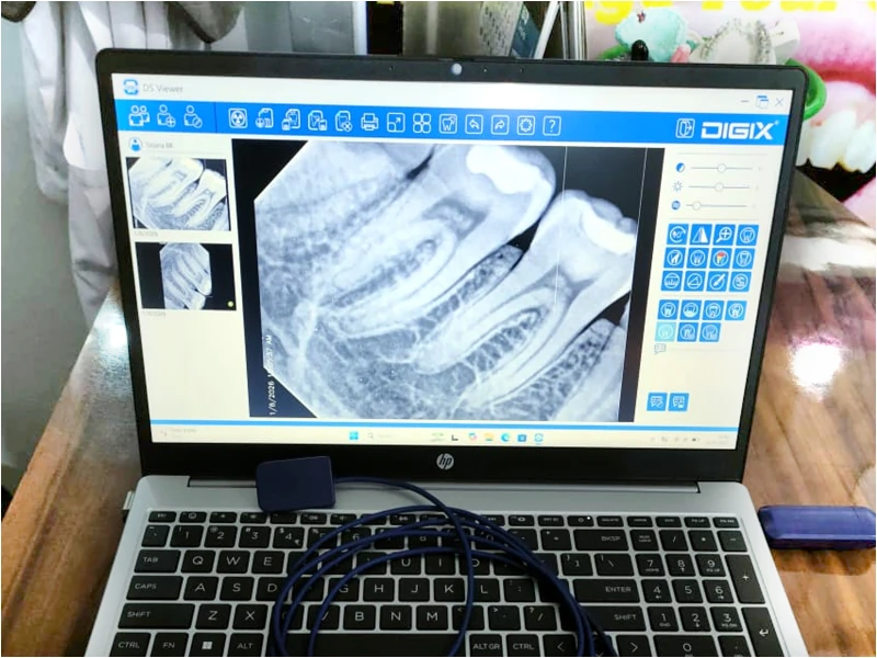 Digital dental X-ray displayed on a clinic computer